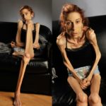 Rachel Farrokh anorexia