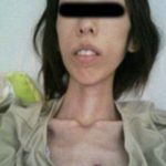 FOTOS- Chica que sufría abuso comparte imágenes de cuando pesaba ¡16 kilos!5