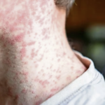 Suman 28 muertes por sarampión en México